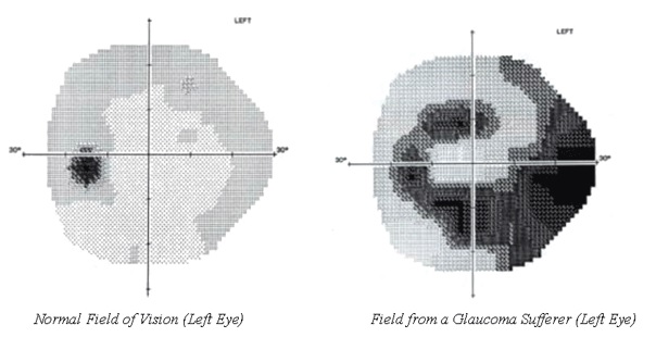 two graphics show the blind spot spreading from a small dot to occupying half the field of vision