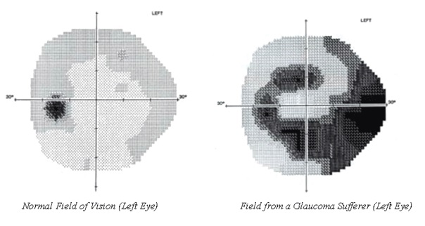 two graphics show the blind spot spreading from a small dot to occupying half the field of vision